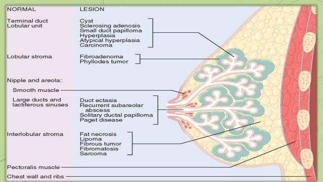 breast cancer histological types Breast cancer histological types